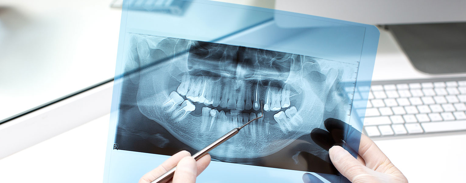Betroffene Zähne